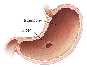 Picture of a gastric ulcer