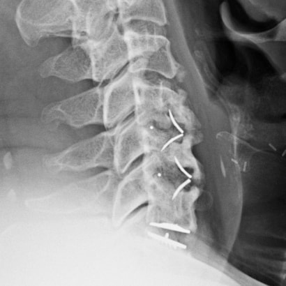 X-ray 2 years after disc replacement at lower level to preserve motion