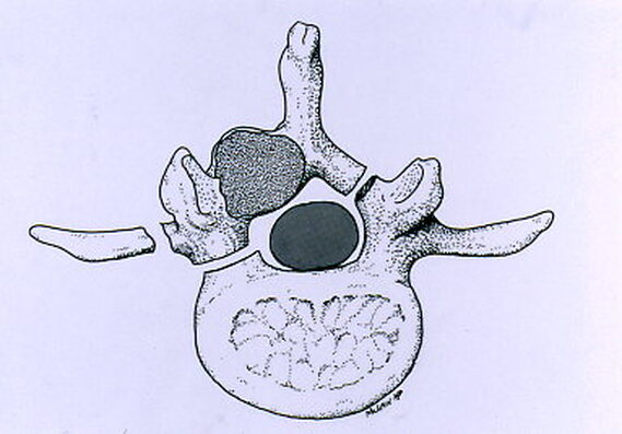 Picture of surgical plan for removing an tumor in the spinal lamina