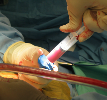 Bone Marrow Aspiration limits need for bone graft 