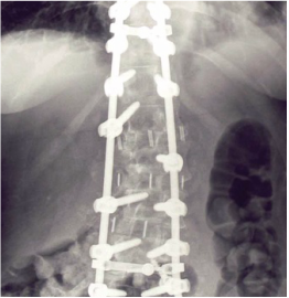 Complex reconstruction of severe adult scoliosis