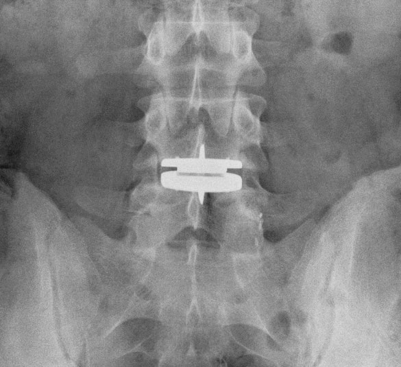 Picture of lumbar disc replacement x-ray