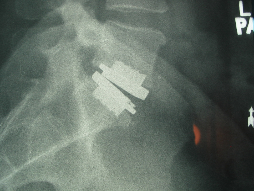 Lumbar total disc arthroplasty