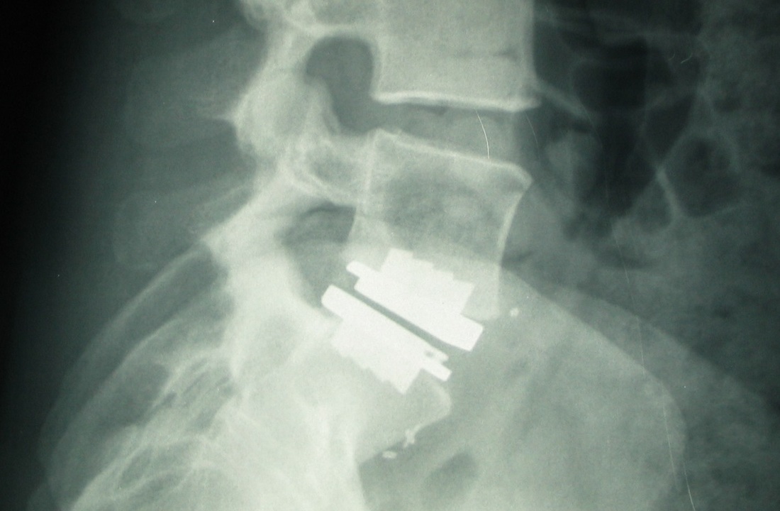 Lumbar artificial disc, or total disc arthroplasty