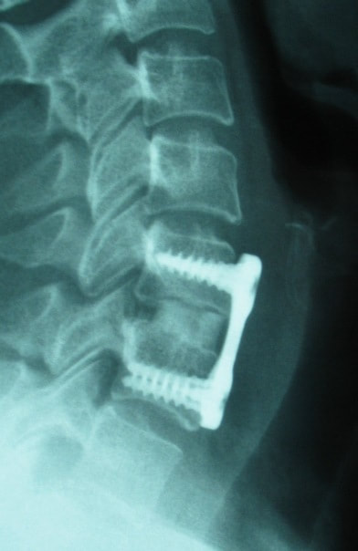 X-ray of single level disc herniation treated by fusion, showing the plate and screws used to hold the spine still as it heals.