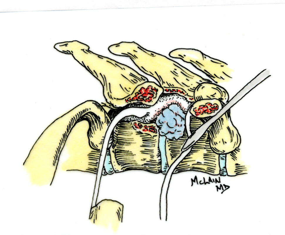 McLain drawing Tumor in the thoracic spine puts direct pressure on the spinal cord