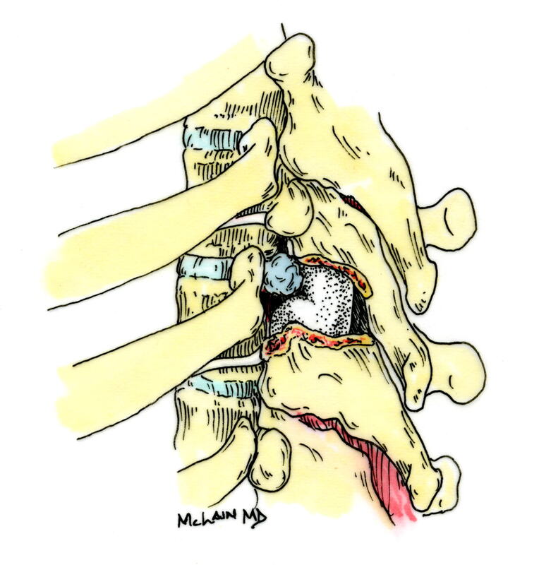 McLain illustration of spinal surgery for thoracic disc herniation