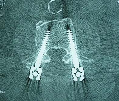 CT scan showing perfect pedicle screw placement