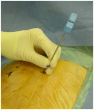 Photo of needle placement for vertebroplasty