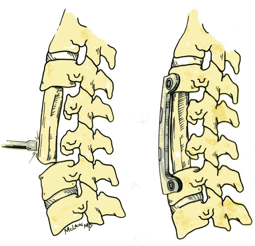 Illustration of cervical spine surgery showing reconstruction of the spine after removal of two complete vertebrae (vertebrectomy or corpectomy) to decompress the spinal cord and relieve myelopathy. (McLain 2016)