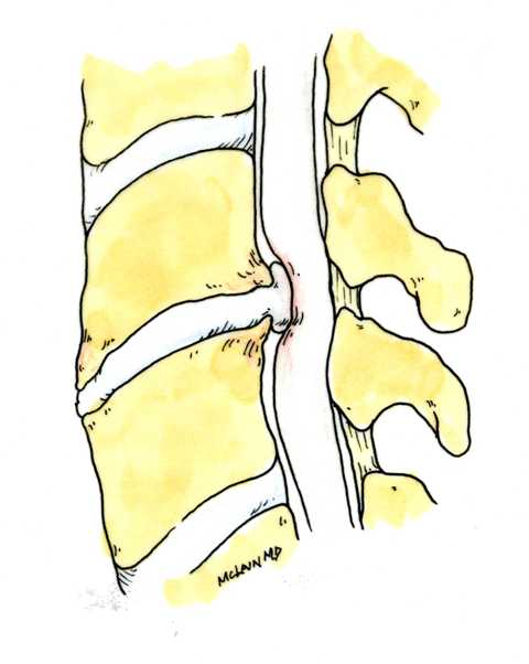 Dr. McLain illustration of cervical disc herniation compressing the spinal cord.