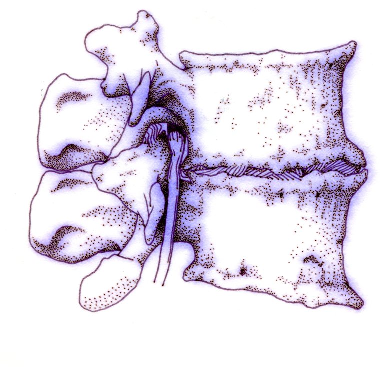 Drawing of degenerative disc disease in lumbar spine