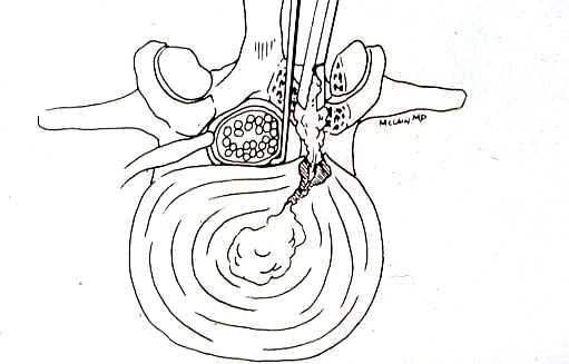 Picture of Microdiscectomy