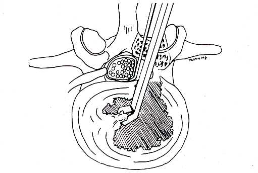 Picture of surgical technique for discectomy and fusion