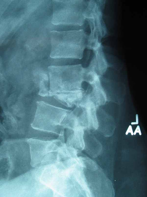 X-ray of spinal destruction by infection by tuberculosis