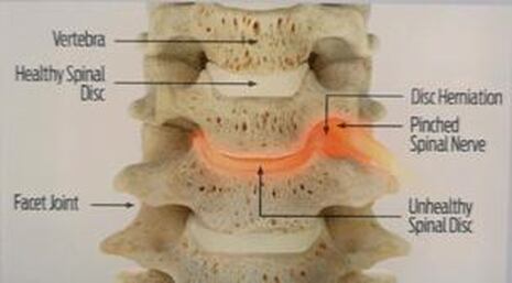 Picture of cervical spine with nerve compression