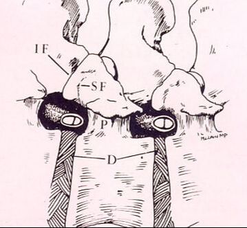 Picture McLain drawing of nerve roots exiting the spinal canal just behind the lumbar discs