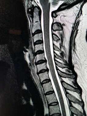 Cervical spine with mild to moderate disc herniations causing neck pain but no spinal cord compression.