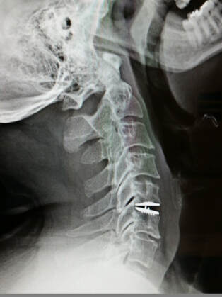 Disc Replacement: Typical postoperative view of a cervical disc arthroplasty implant in optimal position, showing the mobility of the treated disc.  (MobiC implant).