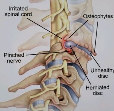 Picture of disc herniation
