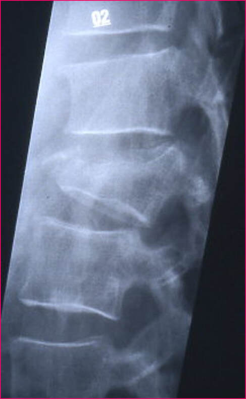 X-ray image of vertebral compression fracture