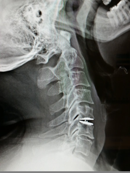 x-ray showing cervical disc replacement in a patient treated for disc herniation