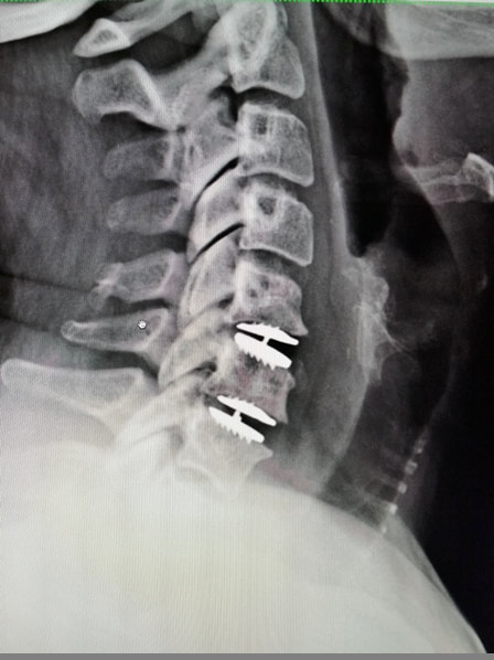 Picture of cervical spine x-ray after two-level cervical disc replacement