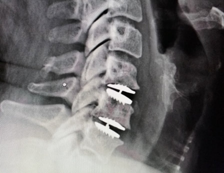 MobiC cervical Total Disc Arthroplasty implants in place. (ZimVie).