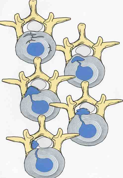McLain illustration of five types of disc herniation in the lumbar spine