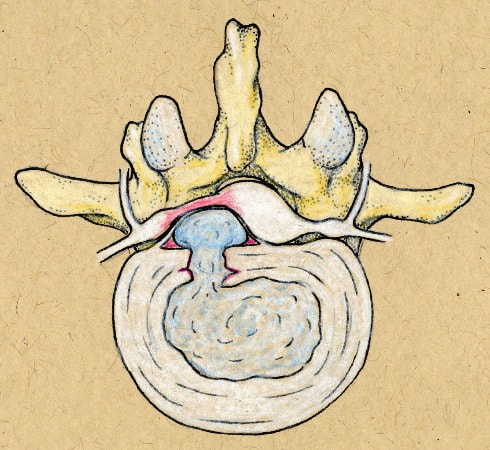 Picture of Dr. McLain Illustration of subligamentous lumbar disc herniation with nerve root compression