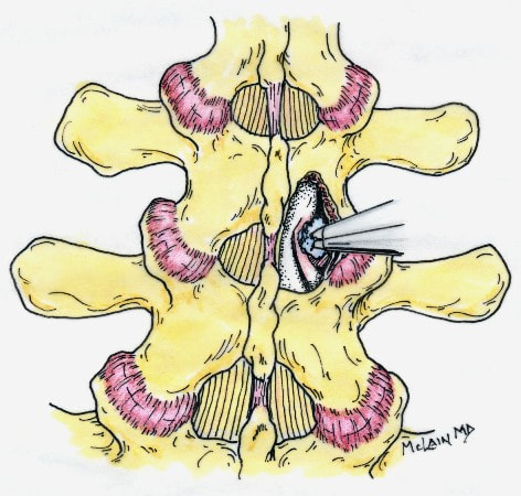 Dr. McLain's drawing of hemilaminotomy and microdiscectomy at L4-L5