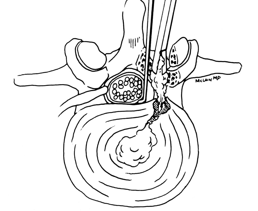 Dr McLain's illustration of microdiscectomy surgery
