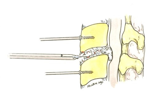 Illustration of anterior cervical discectomy technique used to prepared for total disc arthroplasty, as a treatment of neck pain and cervical radiculopathy.