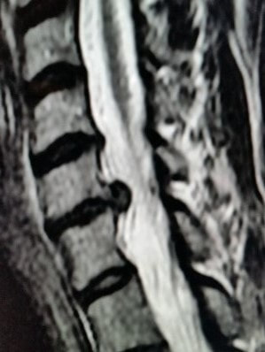 MRI image showing large cervical disc herniation putting pressure on the spinal cord and the nerve roots going out to the arm.