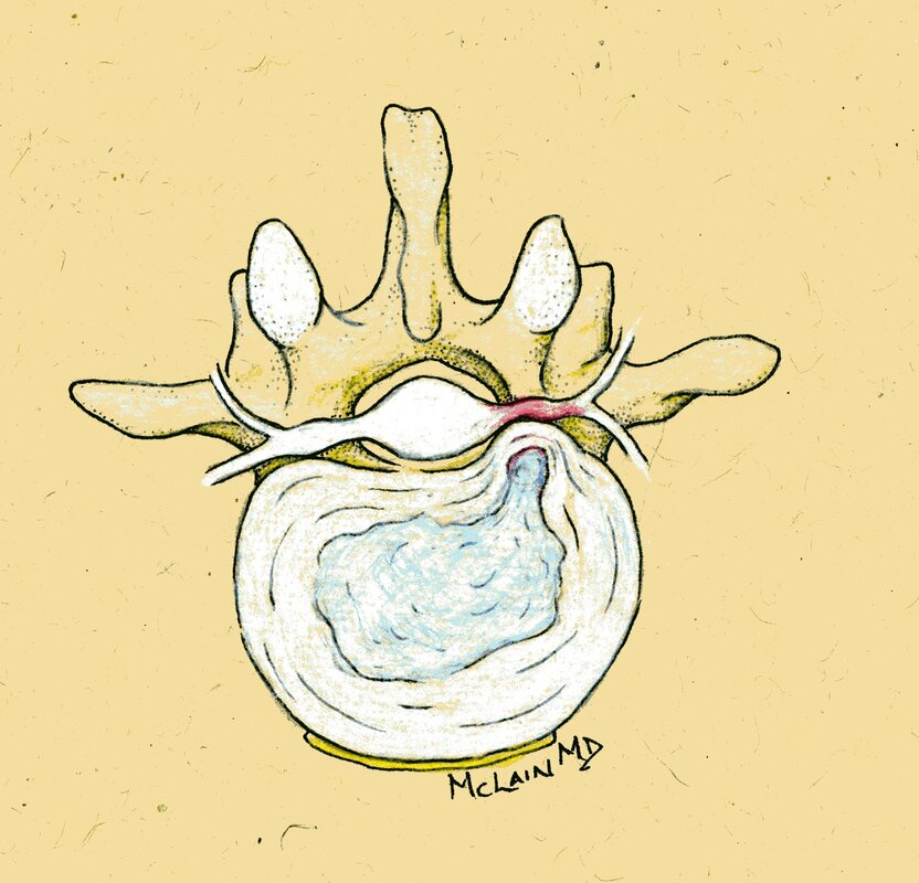 Illustration of lumbar herniated disc or herniated nucleus pulposus, with nerve compression (McLain 2000)
