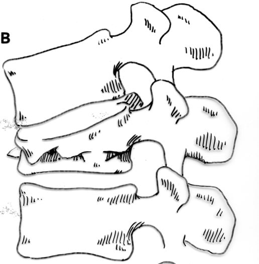 Drawing by Dr. McLain of vertebral compression fracture