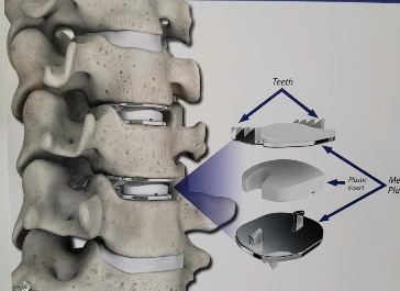 Picture of artificial disc design and position in the cervical spine