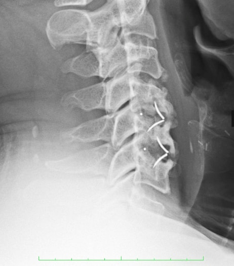 X-ray of patient with a two level cervical fusion (ACDF) just two years before