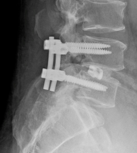 Xray of lumbar TLIF and fusion with interbody cage