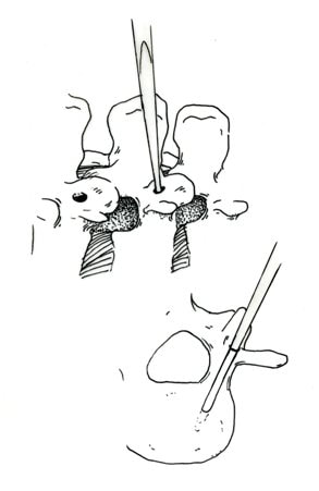 Picture of pedicle screw surgical technique