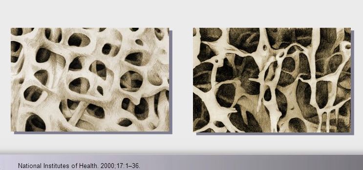 Picture of osteoporotic bone and normal bone