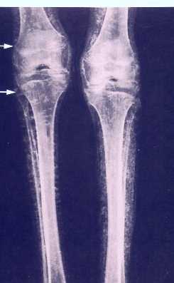 X-ray of knees of Pharaoh Thutmose showing clearly seen growth lines, which typically disappear at the end of adolescence or early adulthood.