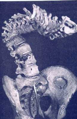 Picture of spine and pelvis of tuberculosis victim showing vertebral destruction (Pott's deformity) and cavity in the pelvic wing due to a large (psoas) abscess.