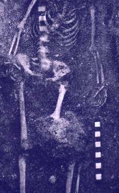 Picture of An enormous destructive lesion was found in the lower extremity of an Iron Age saxon youth buried in an English cemetery.  A radiograph through a peripheral portion of the lesion showed a classic 