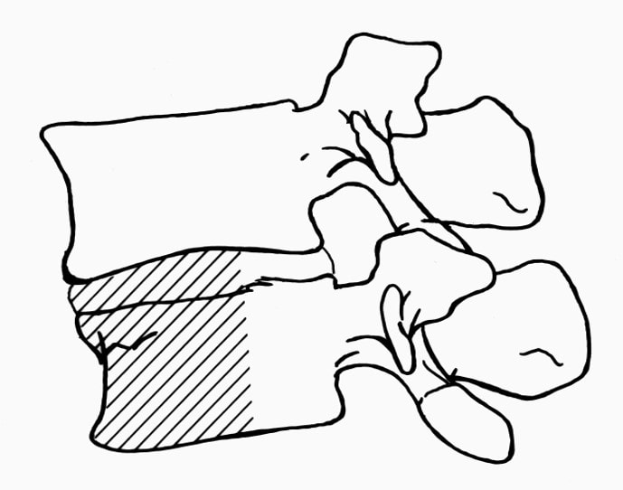 Dr. McLain illustration of minor fracture