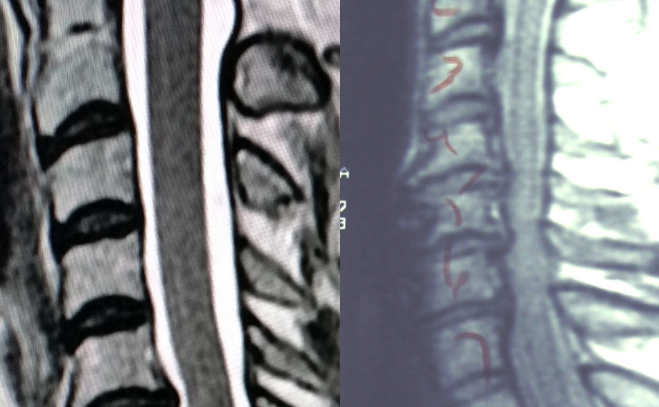 Comparison of the cervical spine with mild to moderate disc herniations to a spine with severe disc disease causing spinal cord compression and myelopathy.