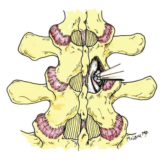 Dr McLain's illustration of spine surgery