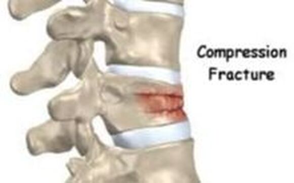 Picture of vertebral compression fracture