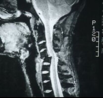 X-ray of spine fracture due to a malignant tumor.  Fusion is absolutely the right thing for this patient.