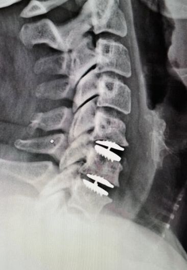 Picture of x-ray of two-level cervical total disc arthroplasty